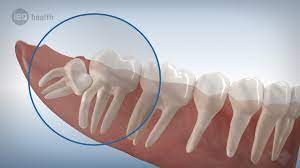 Das entfernen der weisheitszähne zählt zu den häufigsten oralchirurgischen maßnahmen. Zahnarzt Konstanz Weisheitszahne Ziehen Oralchirurgie
