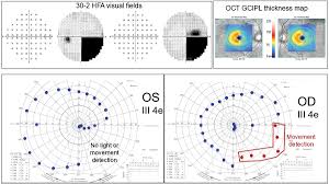 Image result for Visual Field Deficit