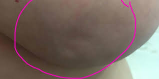 Breast shape (changed breast shape on one side); Woman Posts Photos Of Her Breast Dimples For A Surprising Reason