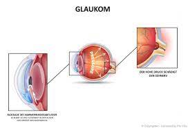 Glaukom