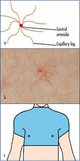 Collection of images with spider man from different parts of movies. Spider Naevi British Journal Of Hospital Medicine
