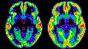 Not all of these patients are schizophrenic. Schizophrenie Definition Symptomes Traitement Causes Qu Est Ce Que C Est