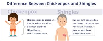Image result for shingles in children