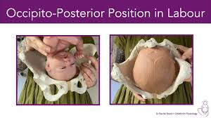 Image result for Manual Rotation in Occipitoposterior Presentation