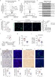 Fatigue can be an early symptom of pancreatic cancer, manifesting even before the diagnosis is made. Suppression Of Tumor Associated Neutrophils By Lorlatinib Attenuates Pancreatic Cancer Growth And Improves Treatment With Immune Checkpoint Blockade Nature Communications