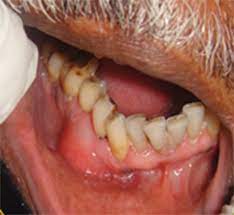 An Unfamiliar Presentation Of A Lateral Periodontal Cyst Bmj Case Reports