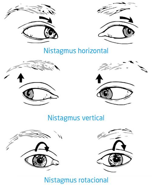 Resultado de imagen para nistagmus"