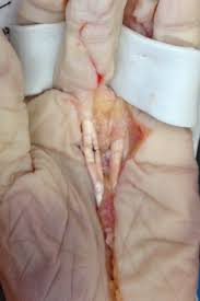 Adamany, md, (phoenix, az) presents a repair technique for a flexor digitorum profundus (fdp) avulsion using nano corkscrew® ft anchors. Aahs Relative Motion Flexion Splinting For Flexor Tendon Repairs Proof Of Concept