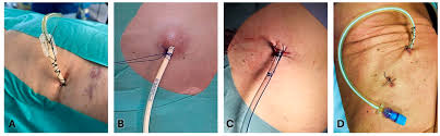 Image result for Small Caliber Chest Tube