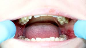 Wisdom tooth pain can come out of nowhere without warning. Help Yourself Recover From Wisdom Teeth Removal With These Tips Dental On Clarendon