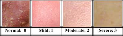 A Color Chart For The Severity Of Erythema Download
