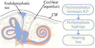 Hearing Loss Associated With Hydrocephalus Practical Neurology