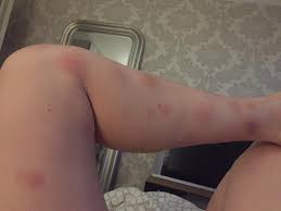 Встречается преимущественно у молодых женщин. Na Nogah Poyavilis Pyatna Pomogite Opredelitsya Chto Eto Takoe Ya Happy Mama
