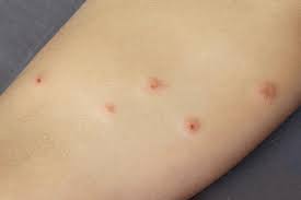 Image result for flea bites