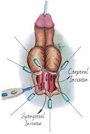 Image result for Priapism