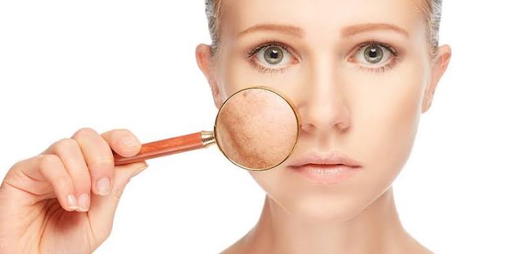 Pigmentation Treatment In Riyadh & Saudi Arabia