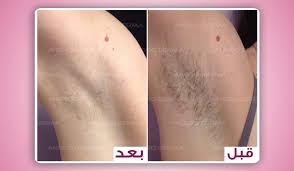 مميزات ازالة الشعر بالليزر 7 مميزات مذهلة عرب تركيا Turkeytoarab