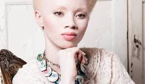 Albinos are HUMAN too (Air-Clinic): In my skin i would win because we are  under the same sun -A true tale of a fighting Albino. — Steemit