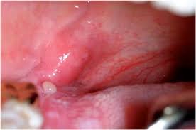 Mouth cancer usually presents with distinctive symptoms and features, such as red or white patches in the mouth, changes in oral tissue, or difficulty chewing or swallowing. Mouth Cancer Screening In Fleet Signs Symptoms