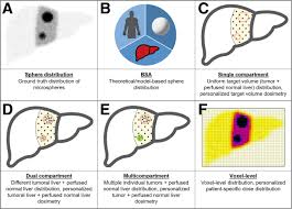 MIRD Pamphlet No. 29: MIRDy90—A 90Y Research Microsphere Dosimetry Tool |  Journal of Nuclear Medicine