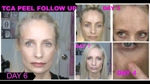 A peel can help even your skin tone. 25 Tca Peel Follow Up Anti Aging Over 40 Tca Peel Before And After Youtube