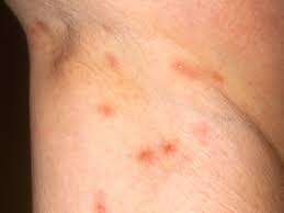 Image result for scabies symptoms