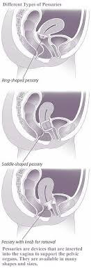 Pelvic Prolapse Non Surgical Treatment