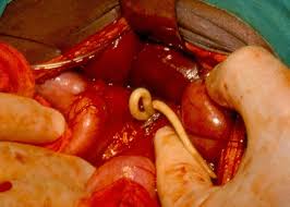 Intestinal Worms Pictures Symptoms And Treatment