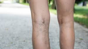 Tiefe Venenthrombose Tvt Ursachen Und Behandlung Gesund Bund De