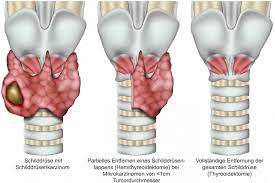 The thyroid gland is an endocrine gland in your neck. Thyroid Cancer Symptoms Treatment Specialists