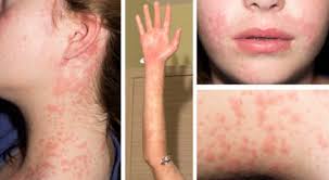 This Case Reports Describes A 15 Year Old Girl Presenting With Unusual Behavior Dysphasia And Emotional Liability S Mortality Rate Dress Syndrome Omeprazole