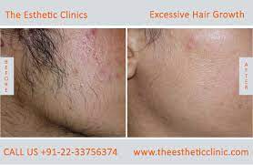 Unless there are signs of excess androgen activity (such as menstrual irregularities, acne, and unwanted hair growth), a hormonal evaluation is usually unnecessary. Excessive Hair Growth Removal Treatment Cost In Mumbai India The Esthetic Clinics