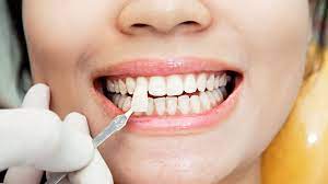 Composite veneers are a quick and affordable option. How Long Do Veneers Last Drake Family Dentistry