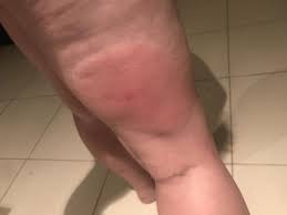 Les piqures de moustiques apparentes et irritantes sont dues à une réponse immunitaire à l'assemblement des anticorps lgg et lge et des antigènes. Tout Savoir Sur La Piqure De Moustique Exemple Allergie Traitement