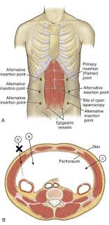 Intestinal or omental injury can occur if the trocar is … Twitter à¤ªà¤° Cirbosque Some4surgery Open Hasson Technique Palmer Point For First Port In Laparoscopic Adhesiolysis For Asbo Salo75 Some4surgery Juliomayol Swexner Misirg1 Pferrada1 Topknife B Kmattox1 Jmills1955 Docmartin22