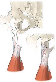 Check spelling or type a new query. Offene Refixation Bei Proximalen Hamstring Verletzungen Springerlink