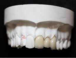 China Dental 3m Lava Full Zirconia Crown By Bright Dental Lab Made In China