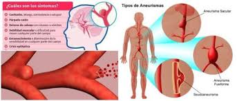 Un aneurisma es una dilatación anormal de la pared de una arteria.cuando la pared de una arteria está debilitada se produce un aneurisma. Aneurisma Causas Tipos Sintomas Complicaciones Diagnostico Tratamiento Tasa De Supervivencia Y Prevencion Arriba Salud