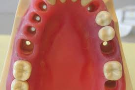 Check spelling or type a new query. What To Do With A Swallowed Dental Crown Dental Implant Abroad