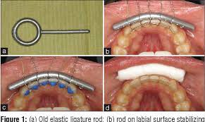 A Simple Technique For Stabilizing Fixed Retainer Wires After De Bonding Semantic Scholar