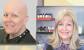 Free Wigs For Cancer Patients