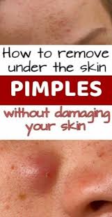 Do You Ve Got A Lump On Your Neck Back Or Behind Your Ear This Really Is What It Means Lumpunderskinonface Hardlumpund In 2020 Pimples Under The Skin Pimples Skin