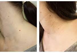 Rodimoe Pyatno Na Shee Chto Oznachaet Rodinka Na Shee Volokonovskij Rajon