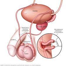 May 12, 2021 · vasectomy reversal is surgery to undo a vasectomy. Reversion De La Vasectomia Mayo Clinic