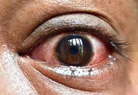 Image result for Eye Pain without Redness