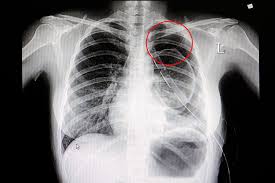 Pneumothorax-Causes-Symptoms-Diagnosis-Homeopathic-Allopathic-Treatment-Dr-Qaisar-Ahmed-Risalpur