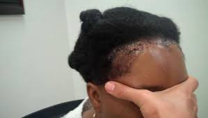 The difference is that this ponytail should not be tight. African Hair Loss Miami Ethnic Hair Restoration In Fl Dr Epstein