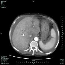 Computed Tomography Findings Of Hepatic Veno Occlusive Disease Caused By Sedum Aizoon With Histopathological Correlation