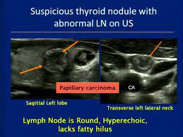 Hashimoto's thyroiditis is the most common cause of hypothyroidism in the us. Thyroid Ultrasound Course Youtube