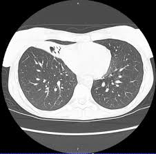 Girls names that start with h are led today by harper, whose meteoric rise to the top 10 has made it the number 1 h name for girls. Mycobacterium Avium Intracellulare Infection Wikipedia